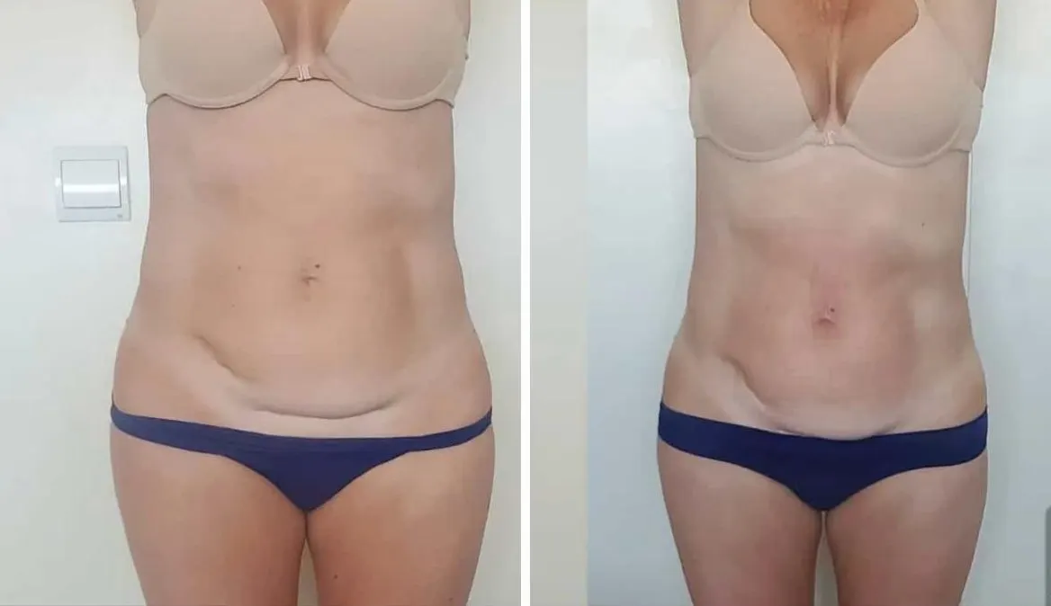 Abdomen antes y después de On Body