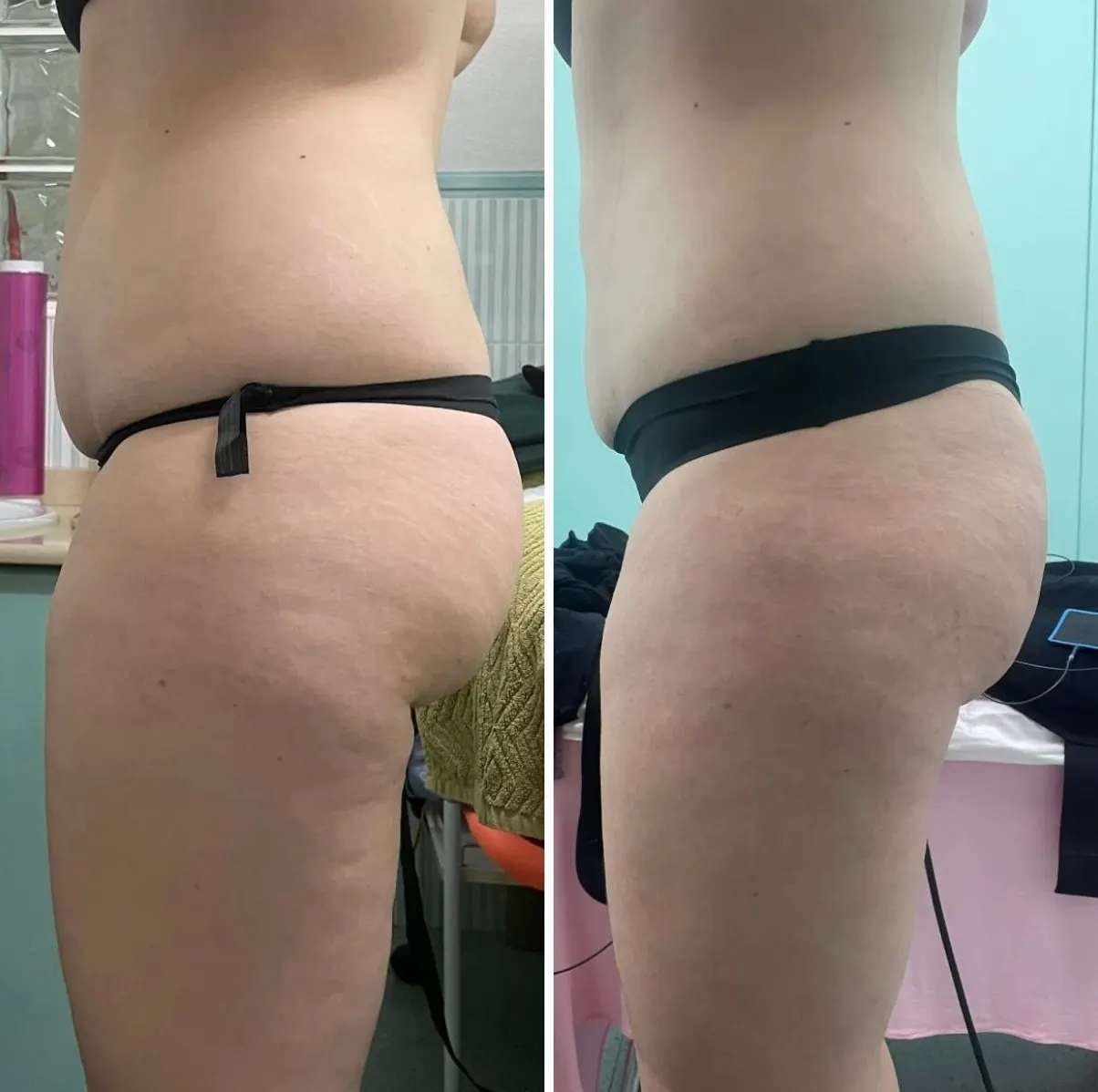 Glúteos y piernas de perfil antes y después de On Body