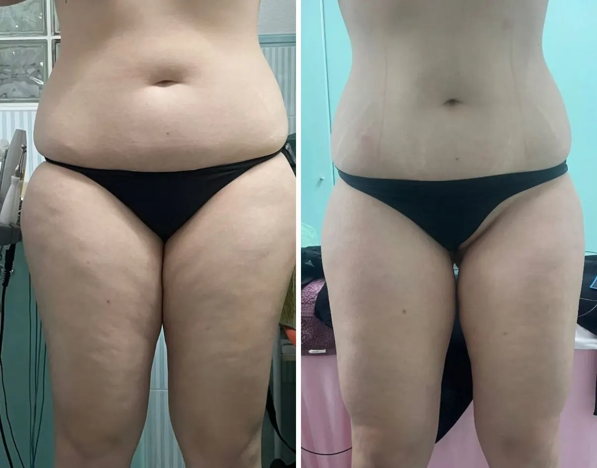 Silueta frontal antes y después de On Body