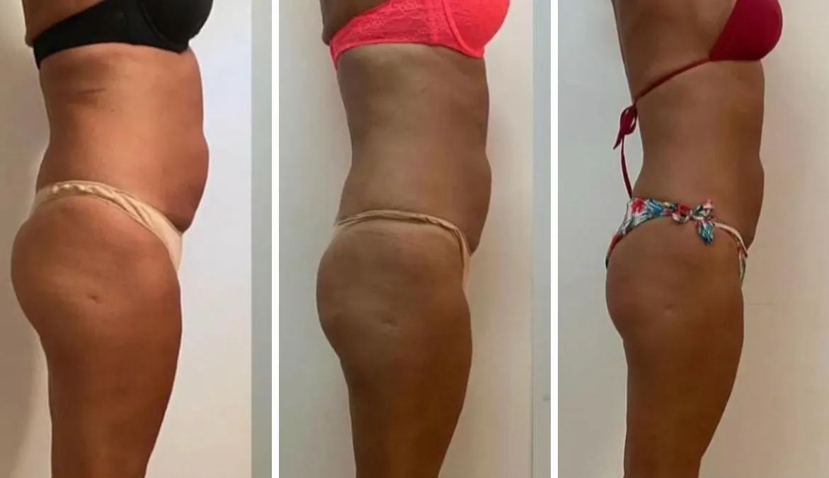 Glúteos antes y después de On Body