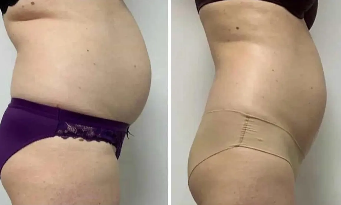 Perfil abdominal antes y después de On Body
