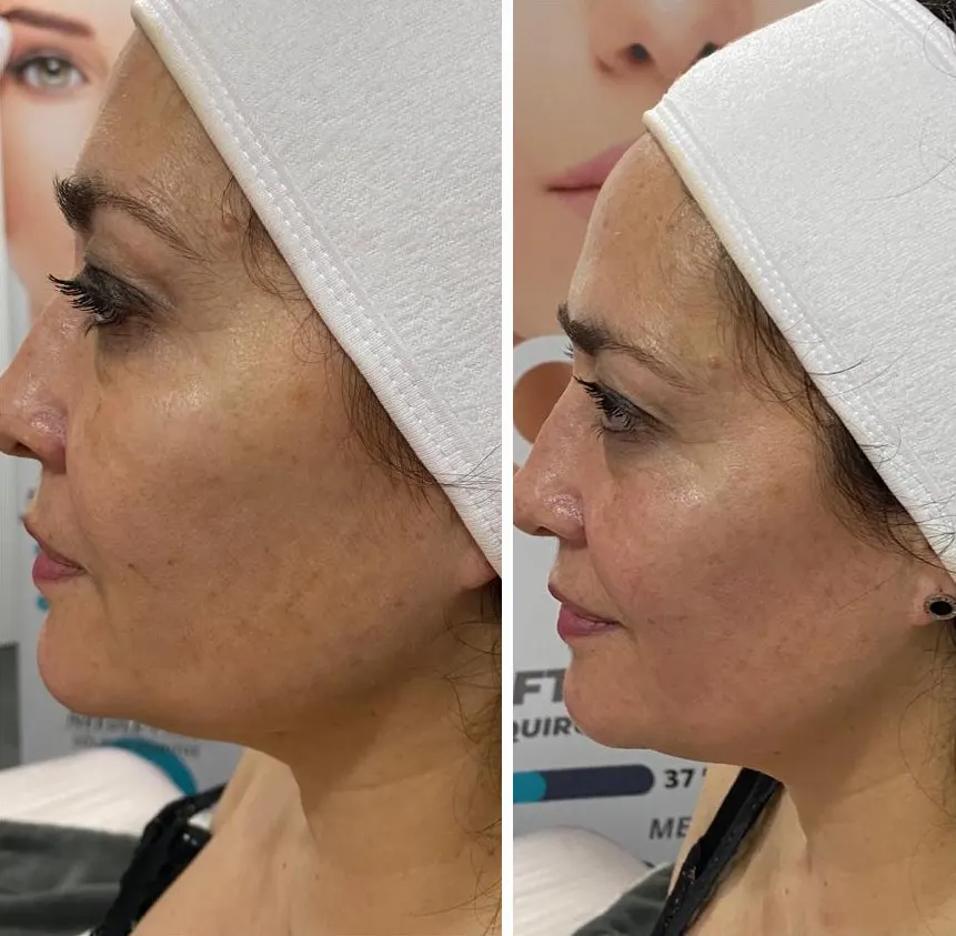 Perfil antes y después de On Face