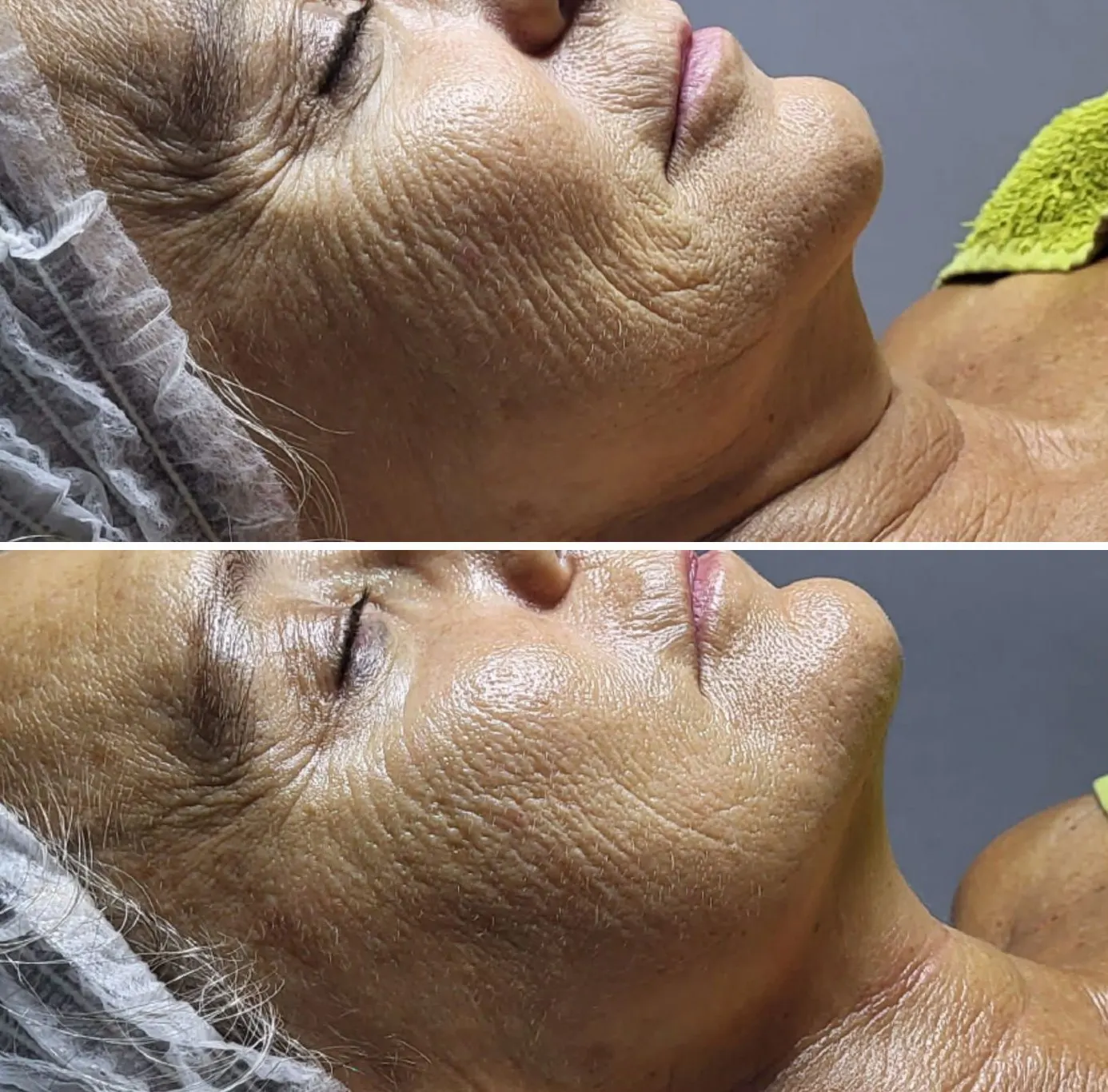 Rostro antes y después de On Face