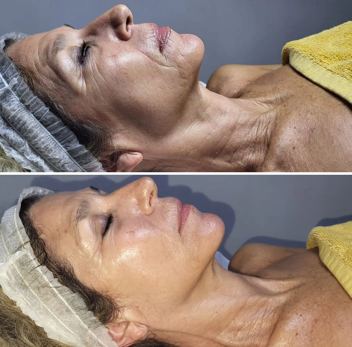 Rostro antes y después de On Face, segunda paciente