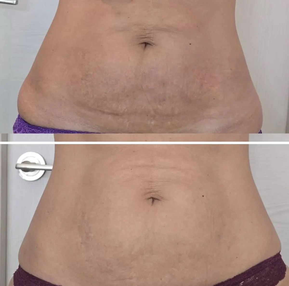 Abdomen antes y después de Luminage