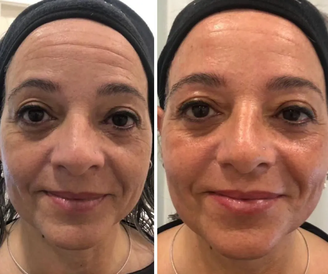 Rostro antes y después de una sesión de Luminage