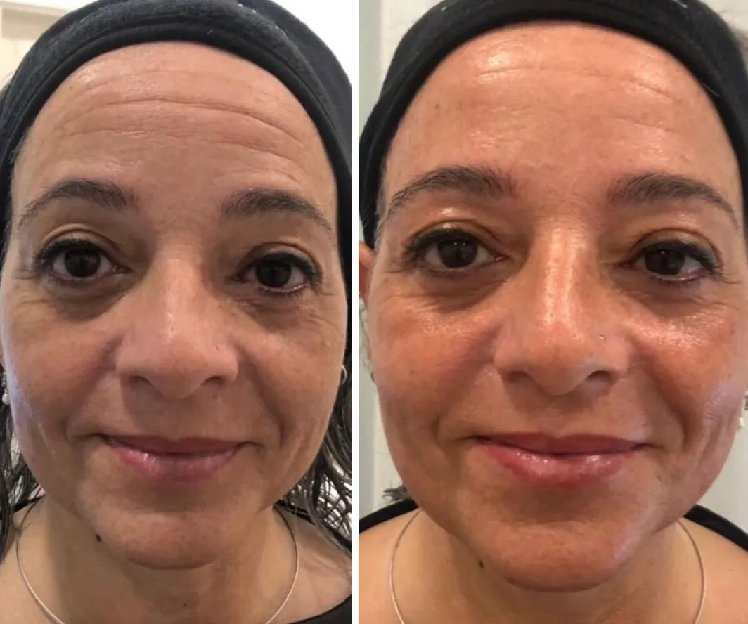 Antes y después de una sesión de Luminage en rostro
