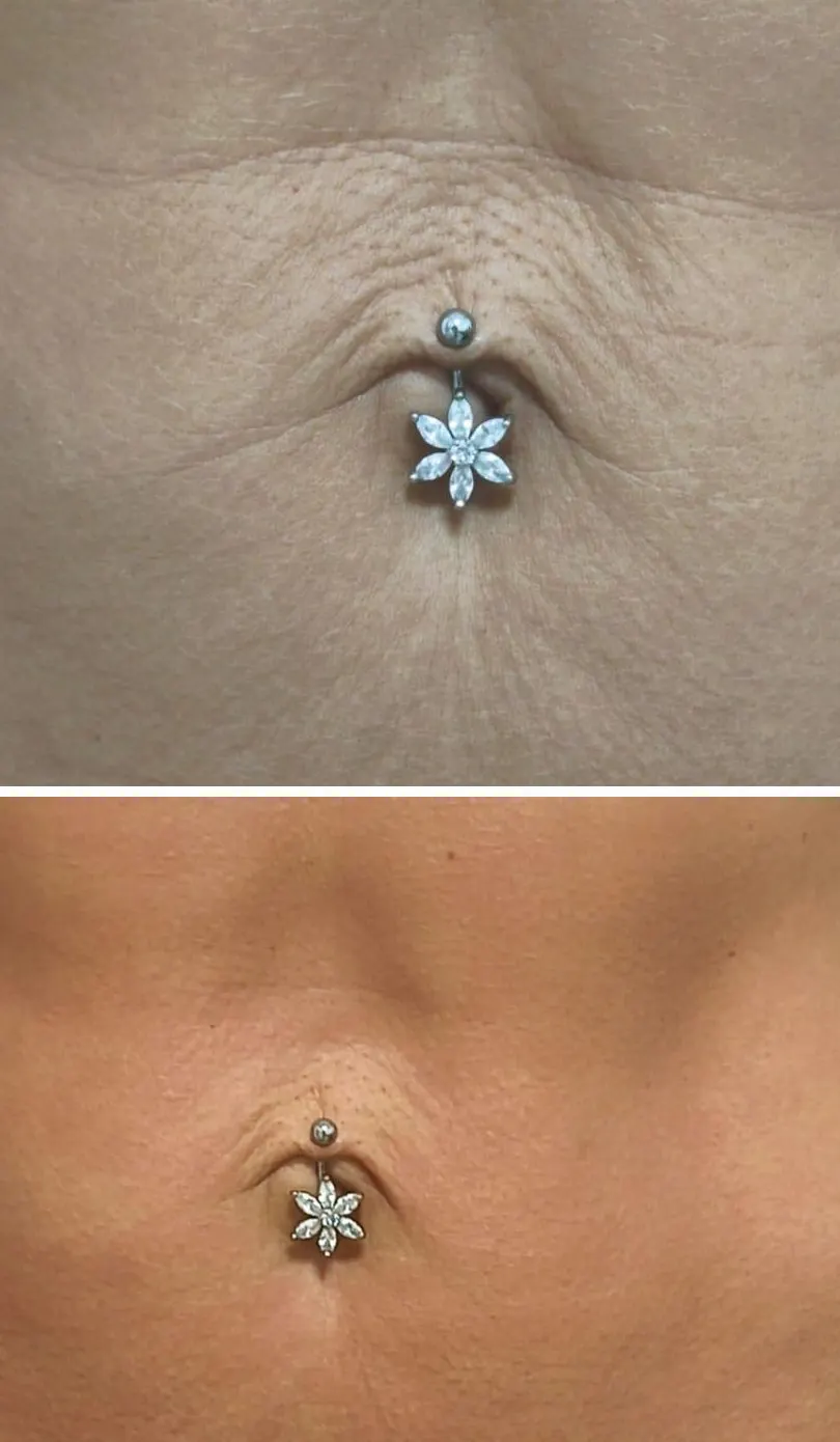 Zona abdominal antes y después de Luminage